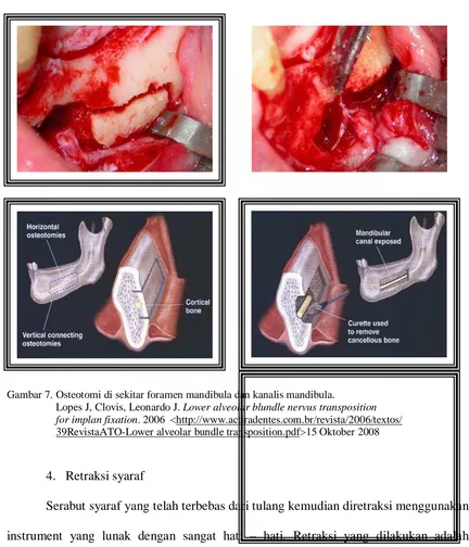 Gambar 7. Osteotomi di sekitar foramen mandibula dan kanalis mandibula.  