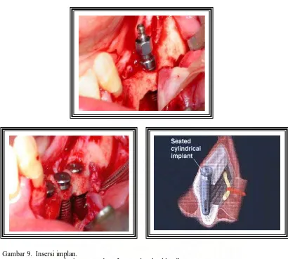 Gambar 9.  Insersi implan.Lopes J, Clovis, Leonardo J. Lower alveolar blundle nervus transposition for implan fixation