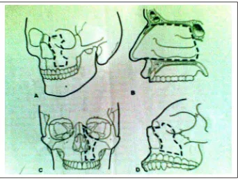 Gambar 5.  Pandangan anteroposterior dan oblik yang menggambarkan osteotomi tengkorak yang diperlukan untuk maksilektomi tengah 10 