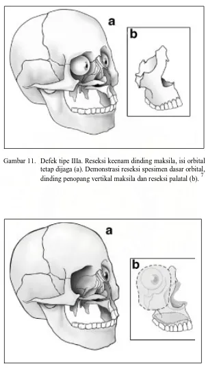 Gambar 12.  Defek tipe IIIb. Reseksi keenam dinding maksila dan isi orbital (a). Demonstrasi reseksi spesimen kelopak mata luar, kulit pipi, isi orbital, kombinasi dengan seluruh maksila dan palatal (b)