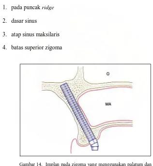 Gambar 14.  Implan pada zigoma yang menggunakan palatum dan tulang zigoma pada lateral tengkorak ke sinus maksilaris dan orbital13  