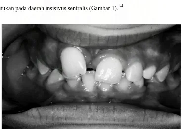 Gambar 1 : Lesi CGCG pada mukosa gingiva gigi insisivus sentralis (Allen DT, Sheats RD