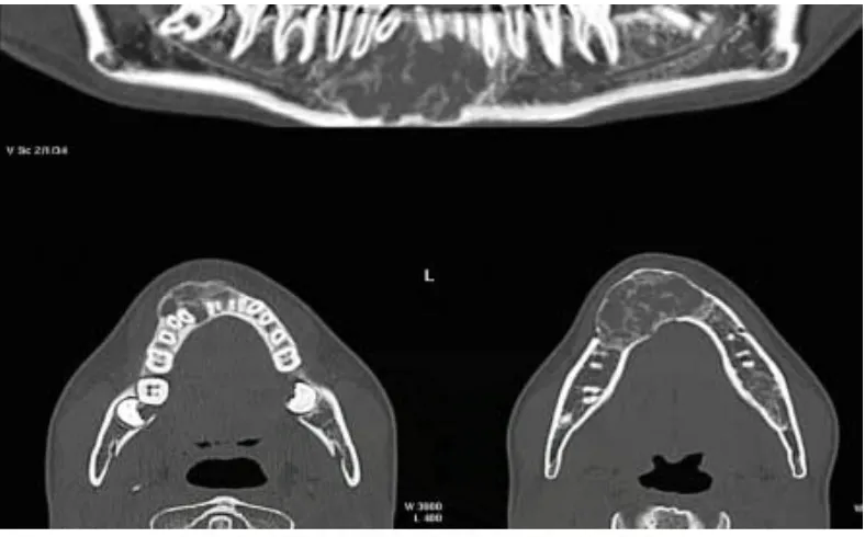 Gambar 6: Gambaran yang menunjukkan adanya lesi CGCGke labial dan bukal rahang bawah dengan pengambilan foto Computed Tomography (CT)