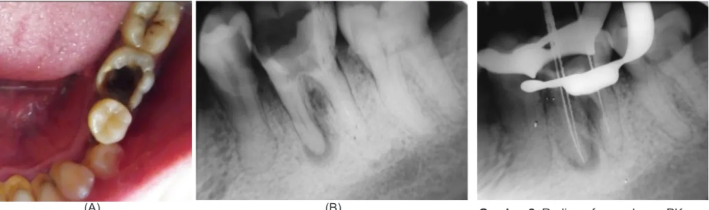 Gambar  1. (A) Keadaan klinis gigi 36 sebelum perawatan; (B) Radiograf periapikal  pre-operatif gigi 36.
