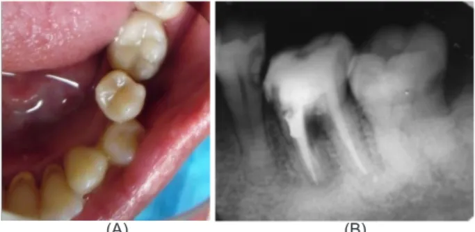 Gambar  10. (A) Keadaan klinis gigi 36 setelah dilakukan  restorasi; (B) Radiograf gigi 36 setelah dilakukan restorasi