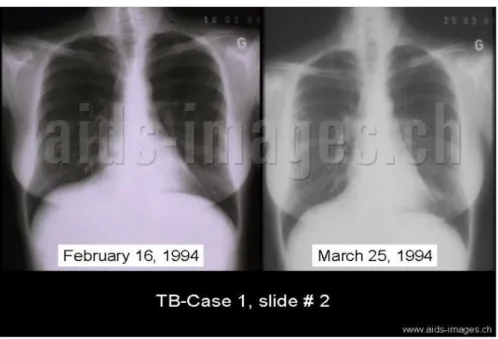 Gambar  2. Gambaran foto toraks TB paru pada ODHA  (perhatikan infiltrat tidak khas seperti pada pasien non HIV) 