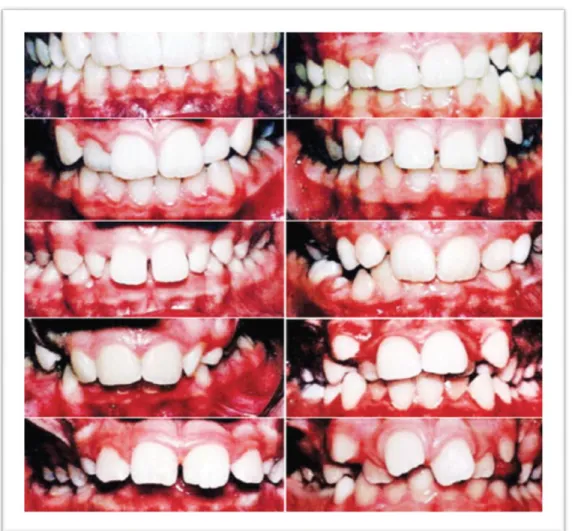 Gambar 2. Komponen estetika berdasarkan Index of Orthodontic Treatment Need . 21 
