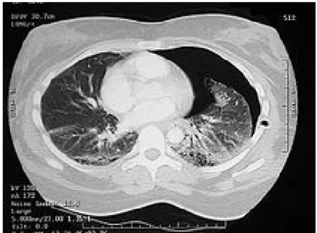 Foto Rö pneumotoraks (PA), bagian yang ditunjukkan dengan anak  panah merupakan bagian paru yang kolaps