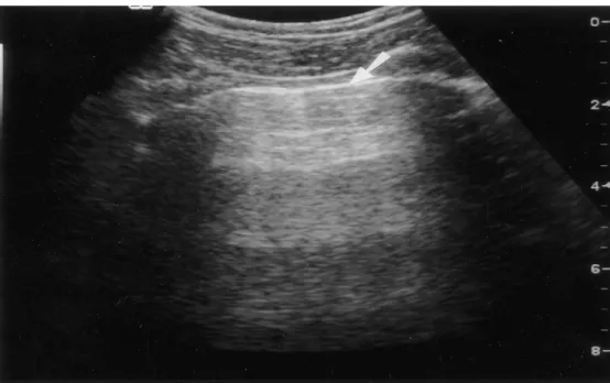 Fig. 1. Example of the pleural/parietal interface where the lungsliding sign would be demonstrated in a dynamic image (arrow at