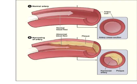 Gambar  potongan  melintang  dari  arteri  serta  pembentukan  plaque  di  dalamnya  dapat  dilihat  pada  Gambar  2