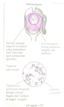 Gambar 4. Kondisi Vagina dalam kondisi  Vaginosis Bakterial 13 