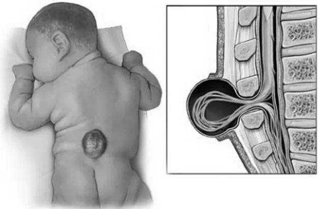 Gambar 2.1. Spina Bifida 22 