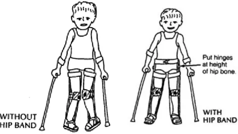 Gambar 1. 4 Orthosis untuk kontraktur pada lutut dan panggul, (Werner 2007)  1.1.2.2.  Mendukung posisi sendi dan gerak normal 