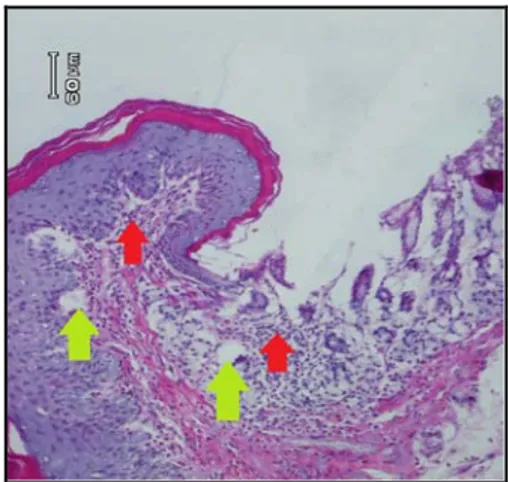 Gambar  1.  Gambaran  mikroskopik  lambung  tikus  Wistar  kelompok  A.  Terlihat adanya sel-sel radang  (panah kuning) pada lapisan mukosa dan mukus pada  permukaan mukosa (panah hitam)