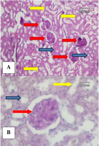 Gambar 2 .  Gambaran mikroskopik ginjal tikus  wistar kelompok B. Tampak cast hialin (panah  biru),  sel  epitel  yang  membengkak  (panah  merah),  dan  sel  nekrosis  (panah  kuning)  A: 