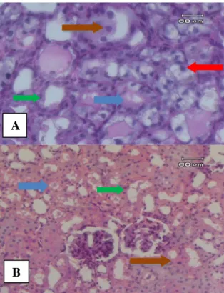 Gambar 5. Gambaran mikroskopik ginjal tikus  wistar  kelompok  E.  Tampak    banyak  cast  (panah  biru),  pembesaran  sel  epitel  (panah  merah),  nekrosis  (pnah  hijau)  dan  sel  radang  limfosit (panah kuning)