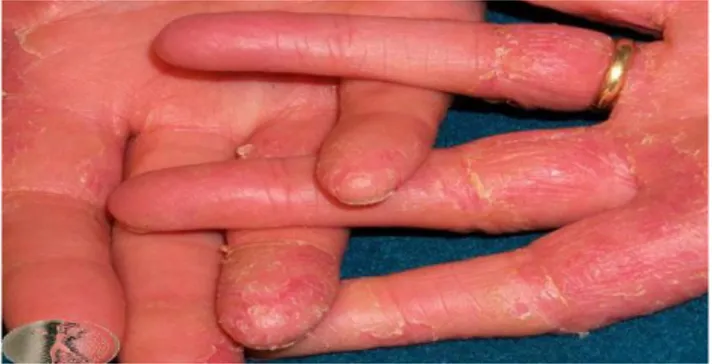 Gambar 1. Dermatitis kontak iritan akibat mencuci pakaian 14  2.1.3.2   Dermatitis Kontak Alergi 