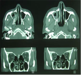 Gambar 1 Hasil CT Scan Sinus Paranasalis Pra BSEF 