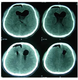 Gambar 2 Hasil CT Scan Sinus Paranasalis Pasca BSEF 