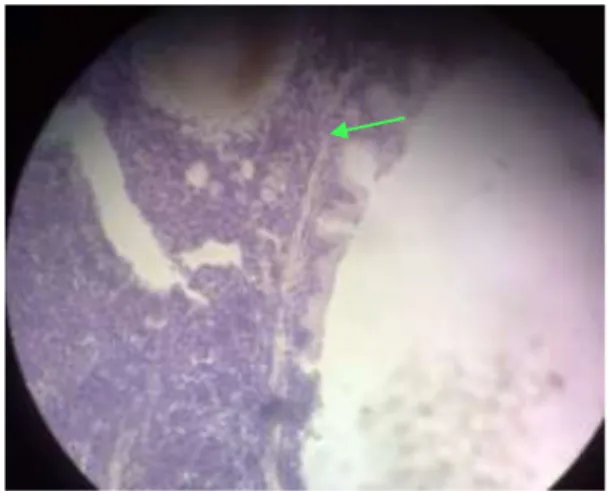 Gambar 4.2. Gambaran mikroskopis derajat inflamasi bronkus mencit                                      Balb/C grade 3