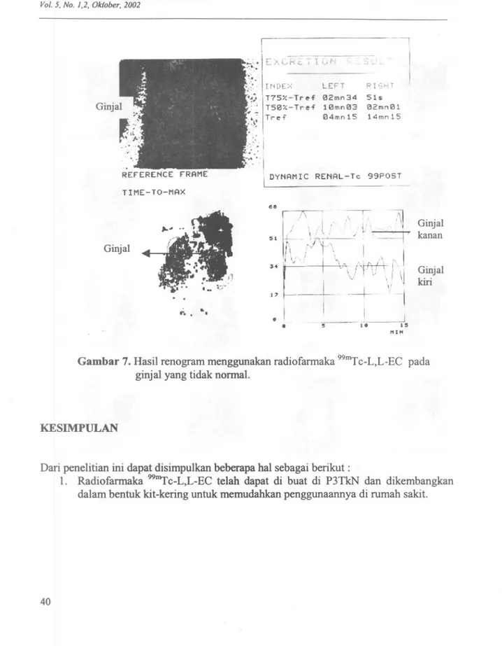 Gambar 7. Hasil renogram menggunakan radiofarmaka 99&#34;&#34;Tc-L,L-EC pada ginjal yang tidak normal.