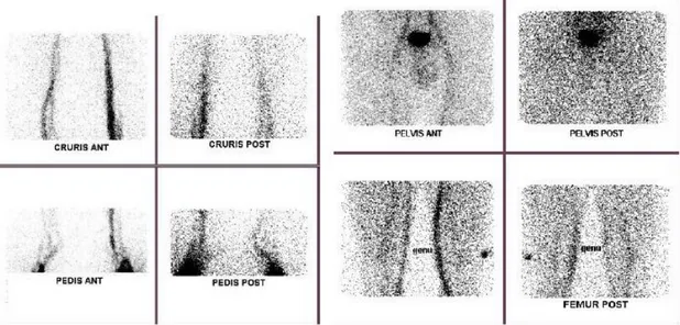 Gambar 5 dan 6,  menunjukan proses  persiapan  volunter  normal  dan  proses  penyuntikan  radiofarmaka  99m Tc-HSA-  nanosfer  secara  intradermal