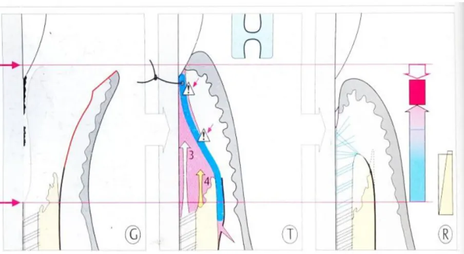 Gambar  1.  Penyembuhan  setelah  metode  GTR.  (G)  setelah  dilakukan  bedah  flep.  (T)  Membran  (warna  biru)  memisahkan  jaringan  epitel  dan  jaringan  ikat  dari  permukaan  gigi, ligament periodontal dan  tulang