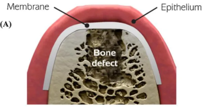 Gambar 2. Skematik metode Guided Bone Regeneration 7 
