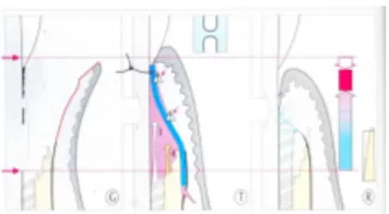Gambar 1.  Penyembuhan setelah metode GTR. (G) sete- sete-lah dilakukan bedah flep. (T) Membran  (war-na  biru)  memisahkan  jaringan  epitel  dan   ja-ringan ikat dari permukaan gigi, ligament  pe-riodontal dan tulang