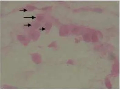 Figure 3.  The features of HeLa cells implanted into cutaneous tissue. Results of H&E staining (1000x magnification) showed cells of similar size with the nuclear volume larger than that of cytoplasm