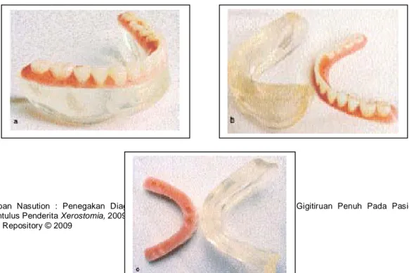 Gambar 11. Anasir gigitiruan mandibular split-denture,           di modelir  dan  dioklusikan  dengan anasir          gigitiruan rahang atas  25 