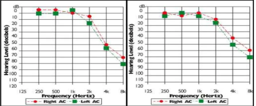 Gambar 5a. Audiogram sensory presbyacusis;  