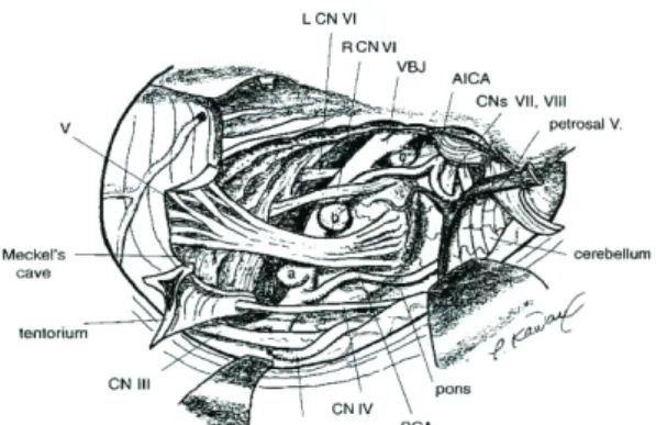 Gambar 5 Letak Aneurisma dan Nervus Kranialis: a) Aneurisma Basilar Trunk Atas,  b) Aneurisma Bifurcation AICA, dan c) Aneurisma Vertebrobasilar 