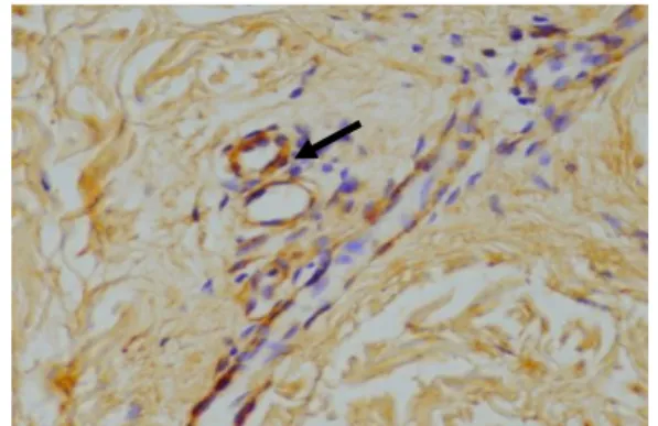 Gambar  2.  Ekspresi  TGF-β  pada  sel  Treg  dari  lesi  pasien  kusta  tipe  BB  (didapatkan  CD25  yang  berwarna  merah  pada  membran  sel  di  dermis  dan  TGF-β  berwarna  coklat  pada sitoplasma sel)