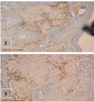 Gambar  1.  Ekspresi sel  T  CD4,  masuk menyusup  ke  dalam granuloma (100x) 
