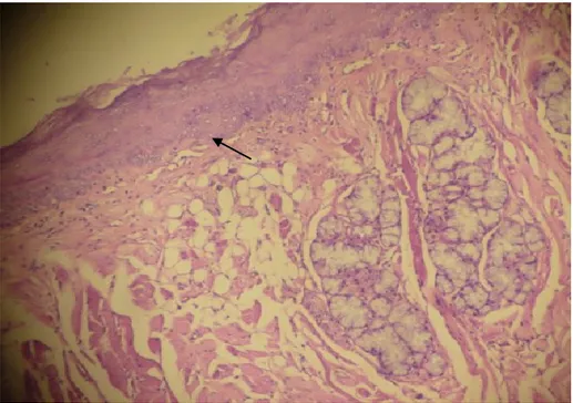 Gambar  8.  Epitel  nasofaring  displasia  ringan.  Tampak  penebalan  pada  epitel  mukosa, silia menghilang dan adanya proliferasi atau hiperplasia dari lamina basalis  dan parabasal yang tidak melebihi sepertiga epitel (tanda panah)