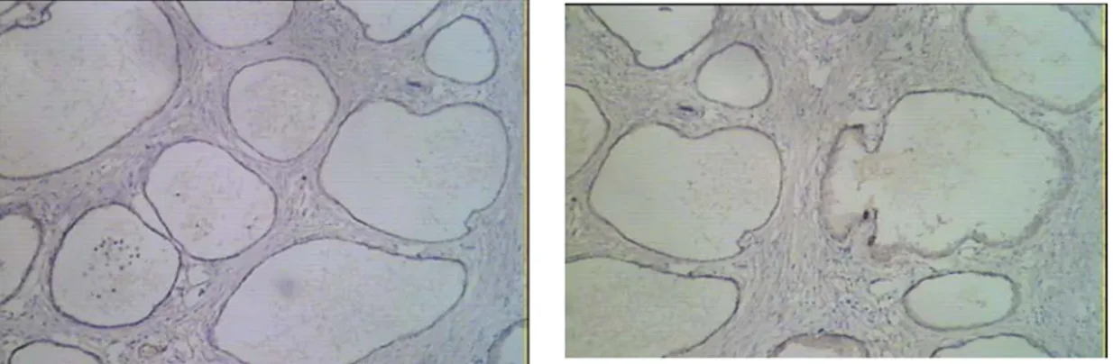 Gambar 1.  Hiperplasia Prostat Pulasan dengan   Gambar 2.  Hiperplasia Prostat Pulasan  dengan anti P63, 50X        anti P63, 50X 