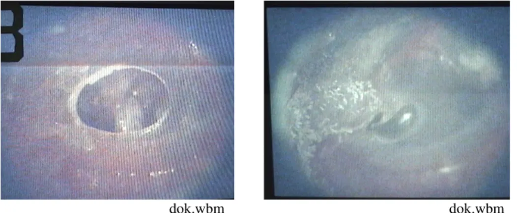 Gambar 7. Contoh perforasi membrana timpani sebelum diaplikasi TCA 10%(kiri), dan               terjadi  penutupan  (kanan)  setelah 1 kali aplikasi