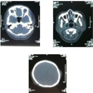 Gambar 4. CT Scan dengan kontras setelah operasi,  (a dan b) menunjukkan tidak adanya destruksi tulang  bagian frontal dan tegmen terpapar (c) menunjukkan  sudah tidak adanya akumulasi pus pada ruang  subgaleal.