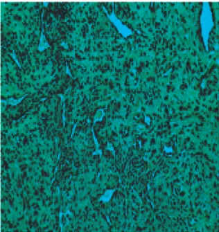 Gambar 1. Kasus 1. Angiofibroma. Massa tumor  terdiri atas komponen jaringan ikat dengan sel  berbentuk spindel, bulat dan stellata
