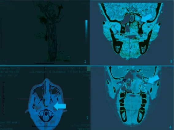 Gambar 3. Tomografi komputer angiografi dan analisis osiriX kasus 3. 1. Arteri yang memperdarahi tumor; 2