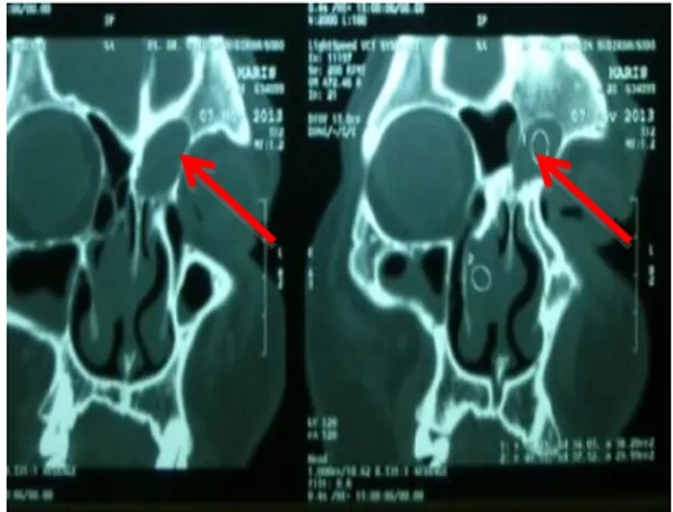 Gambar 4. CT Scan kepala potongan  koronal: Tampak massa batas tegas, regular  pada region meatus nasi medius dan sinus  frontalis sinistra