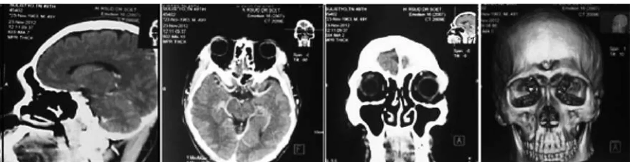 Gambar 4. Foto CT-scan kepala fokus sinonasal irisan aksial, sagital dan koronal dengan  dan tanpa kontras 6 bulan pasca BSEF