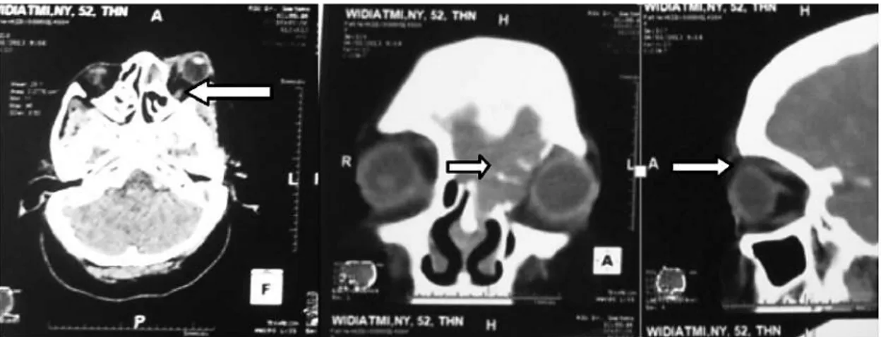 Gambar 12. CT-scan kepala irisan axial reformatted coronal, dan sagital