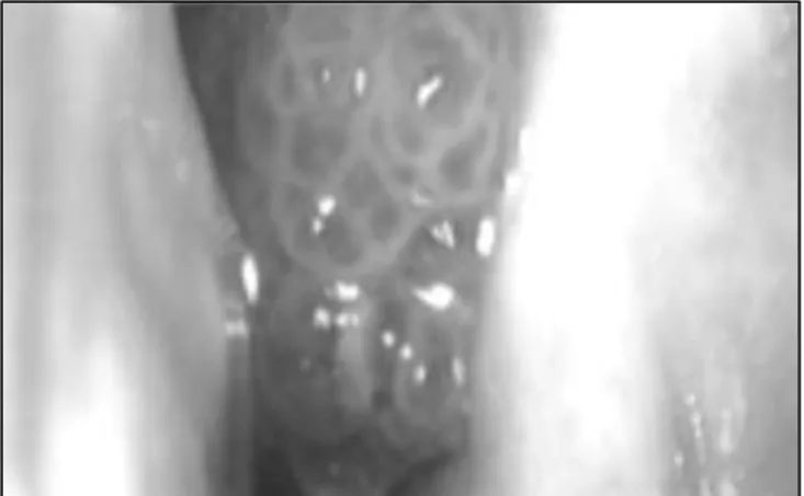 Gambar 2.1. Gambaran klinis papiloma inverted berupa gambaran granuler  yang menyerupai mulberry
