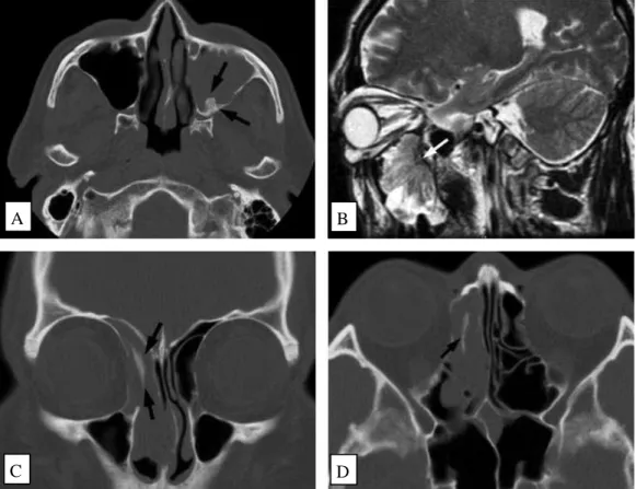 Gambar 2.4. Gambaran hiperostosis menyerupai kerucut pada sinus maksila  pada CT-scan (A)