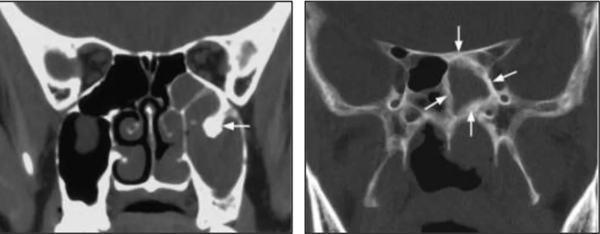 Gambar 2.5. Gambaran hiperostosis pada pemeriksaan CT-scan, perlekatan  tumor (kiri) dibandingkan dengan hiperostosis difus karena sinusitis 