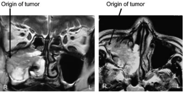 Gambar 2.6. Gambaran dari serpentine cerebriform filamentous structure  (SCF) pada pencitraan MRI, pangkalnya berupa asal tumor