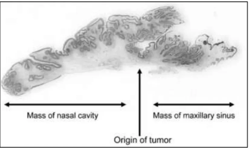Gambar 2.7. Perluasan tumor yang sentrifugal dengan pusat peluasan  merupakan lokasi awal perlekatan tumor