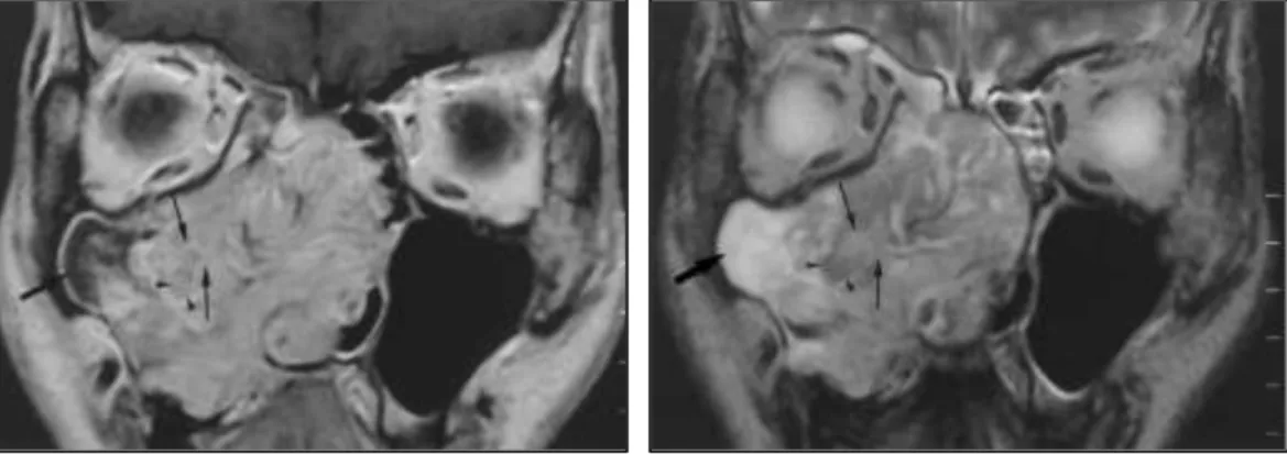 Gambar 2.8. Perbedaan pemeriksaan MRI T 1 -weighted  dengan kontras  (kiri) dan T 2 -weighted tanpa kontras (kanan)